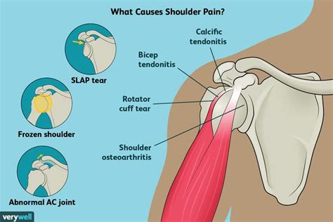 Pin on physical therapy exercises for shoulder pain