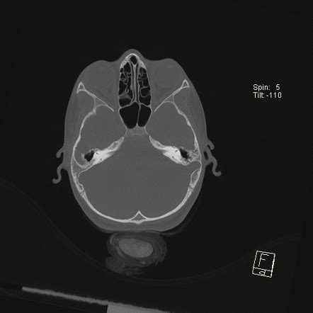 Sigmoid sinus diverticulum | Radiology Reference Article | Radiopaedia.org