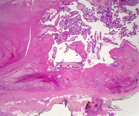 Pathology Outlines - Placenta accreta, increta and percreta