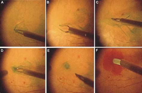 Vitrectomy with Internal Limiting Membrane Repositioning and Autologous ...