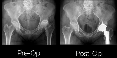 Anterior Total Hip Replacement | Sumit Rana, MD