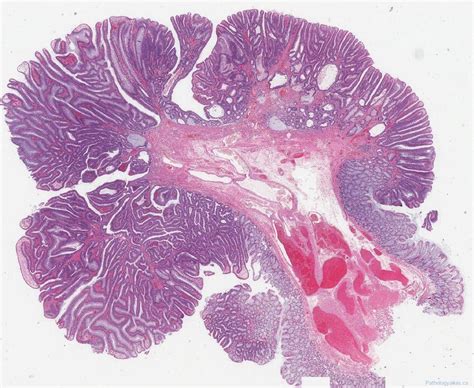 Tubulovillous adenoma of the colon | Atlas of Pathology