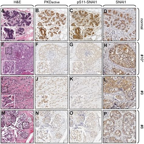 Tissue microarrays (TMAs) including 10 normal breast tissue samples, 40... | Download Scientific ...