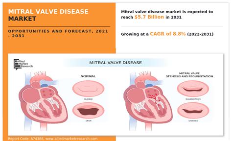 Mitral Valve Disease Market to Witness Tremendous Growth, Projected to ...