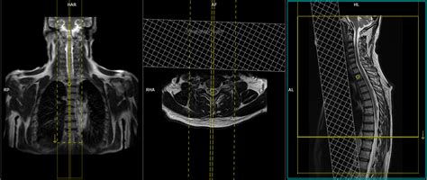 MRI whole spine | MRI whole spine protocol and planning