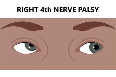 Trochlear Nerve Palsy: Symptoms, Causes, and Treatment