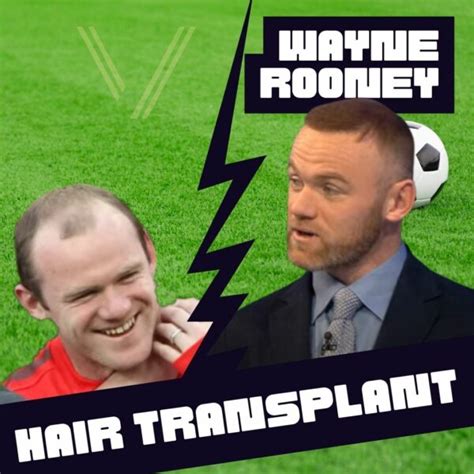 Wayne Rooney's Hair Transplant: Before and After Transformation