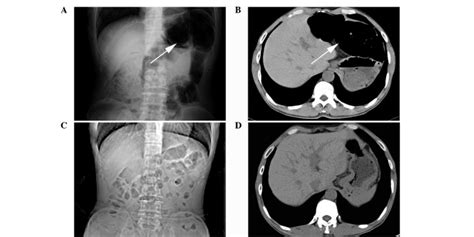 Radiological observations. (A) Plain abdominal X-ray revealed a gas ...