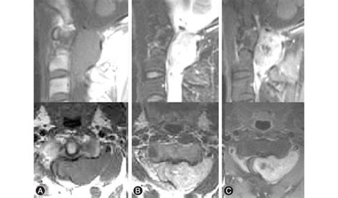 Neurilemmoma with focal hemorrhage. Sagittal and axial T1 (A), T2 (B ...