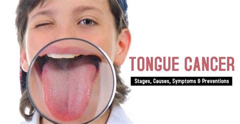 Tongue Cancer- Stages, Causes, Symptoms & Preventions