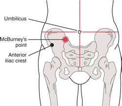 McBurney's point | Nursing school survival, Nursing school info ...