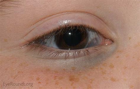 Oculodermal melanocytosis (nevus of Ota)