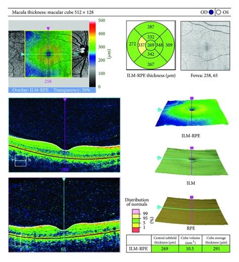 (a) and (b): Normal OCT images of the macula. | Download Scientific Diagram