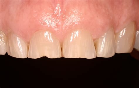 Teeth grinding: causes and treatments - Oakville Dentist - Dentist oakville - Bronte Road Family ...