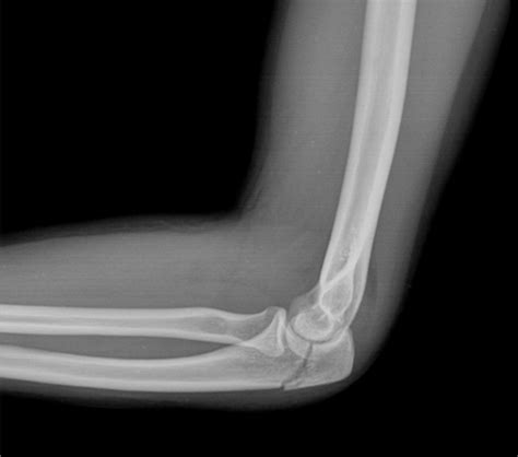 Elbow Fractures: Definition, Symptoms, Causes & Treatment