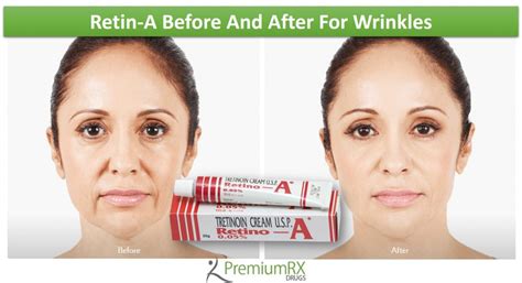 Retin-A Before And After For Wrinkles | PremiumRx- Online Pharmacy