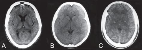 CT scans of adult CM patients from India showing mild to severe brain... | Download Scientific ...