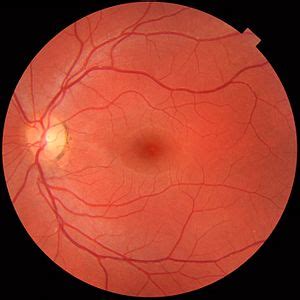 Ophthalmoscopy - Wikipedia