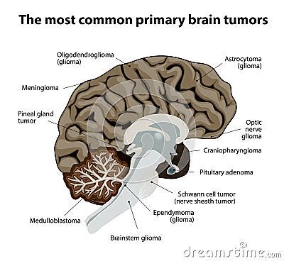 The Most Common Primary Brain Tumors Stock Vector - Image: 46768479