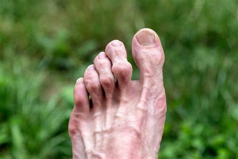 Feet Deformed From Rheumatoid Arthritis Stock Photos, Pictures & Royalty-Free Images - iStock