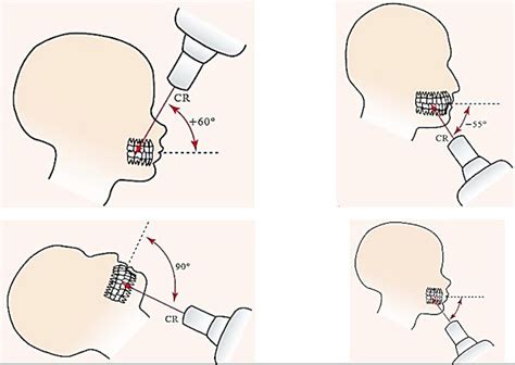 Occlusal technique l Oral radiology MCQs - WikiDentia