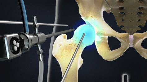 Artroscopia de cadera | Dr. Josué Calderón Gamba