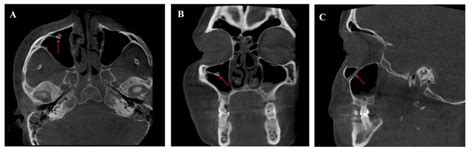 Infraorbital canal was detected in the maxillary sinus; A. Axial plane;... | Download Scientific ...