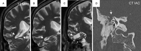 Case 2-CTand MRI findings. A-C, T2 coronal MRI demonstrating a large... | Download Scientific ...