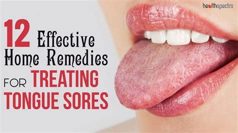 12 Effective Remedies For Treating Tongue Sores | Healthspectra - YouTube