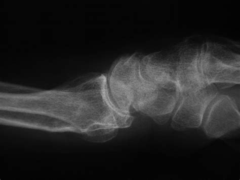 Do young patients with malunited fractures of the distal radius inevitably develop symptomatic ...