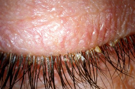 Blepharitis - Stock Image - C034/5697 - Science Photo Library