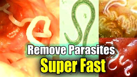 Get Rid of Pinworms! Threadworms Treatment! Remove Parasites from Your Body! - YouTube