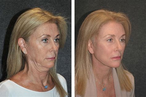 Neck Lift Surgery | Best New York Neck Lift | Necklift Specialist