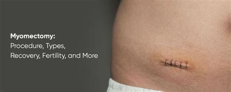 Myomectomy: Procedure, Types, Recovery, Fertility, and More