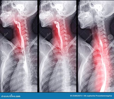 Barium Swallow Procedure UGI Throat Bowel Therapy by Fluoroscopy Devices Stock Image - Image of ...