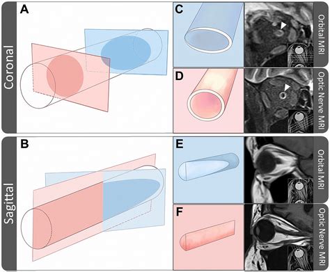 Improved optic nerve visualization and treatment planning through a ...