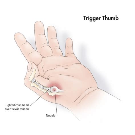 Trigger Thumb Treatment in Kolkata, India | Kids Orthopedic