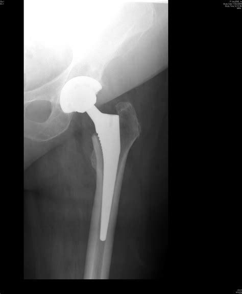 Complications of Total Hip Replacement Surgery/Total Hip Arthroplasty