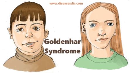 Goldenhar Syndrome – Types, Complications and Symptoms