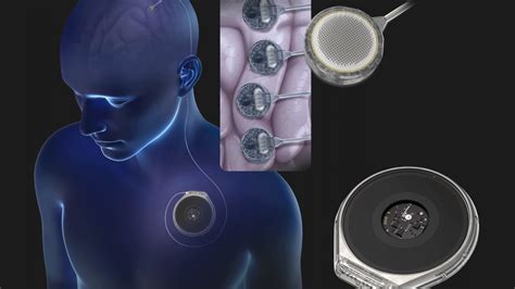 Neuralink competitor Paradromics gears up to test its brain implant on humans - Pro Invest News