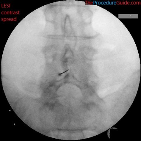 Fluoroscopic Guided Thoracic/Lumbar Interlaminar Epidural Steroid ...