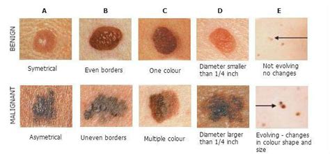 Pin on Skin Moles