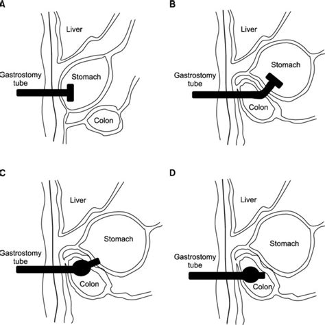 Colonoscopic findings. (A) The opening of the colonic side in ...