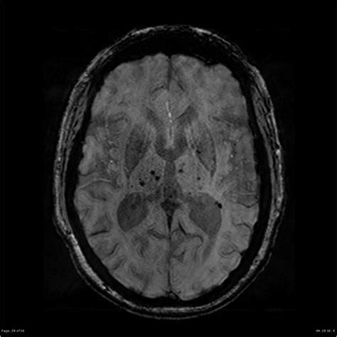 Chronic hypertensive encephalopathy | Radiology Case | Radiopaedia.org | Chronic, Radiology ...