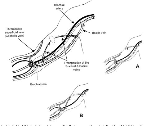 Figure 1 from Combined simultaneous basilic and brachial vein transposition. A new technique to ...