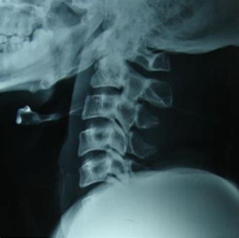 a -Lateral x-rays of the cervical spine showing fusion of the spinous... | Download Scientific ...