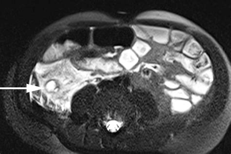 Acute retrocecal appendicitis. MRI in a 4-year-old boy with leukemia ...