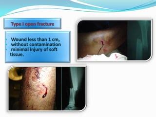 Open Fracture Antibiotics prophylaxis