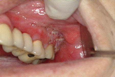 Squamous cell carcinoma of the oral cavity associated with graft versus host disease: Report of ...