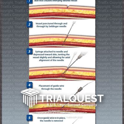 Seldinger Technique for Arterial or Venous Puncture - TrialExhibits Inc.